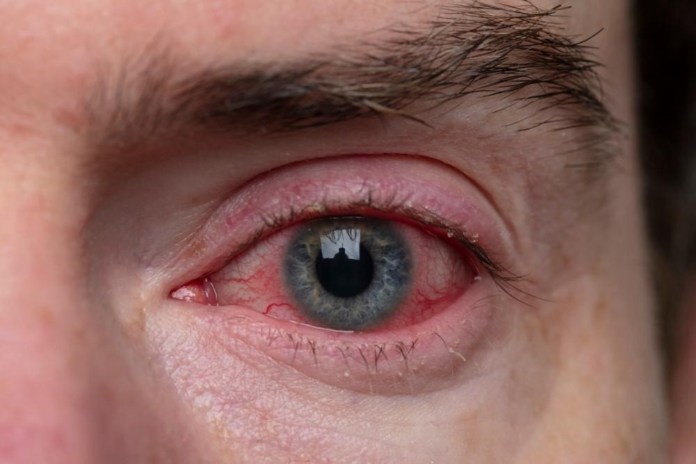 Why Does Blepharitis Become More Common With Age?