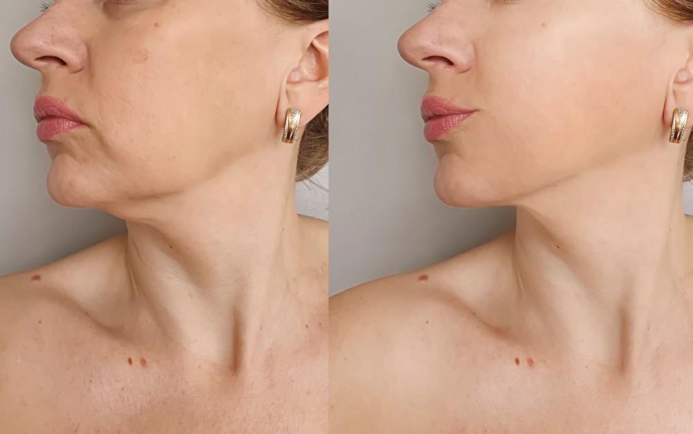 Can Liposuction Cause Sagging Skin?